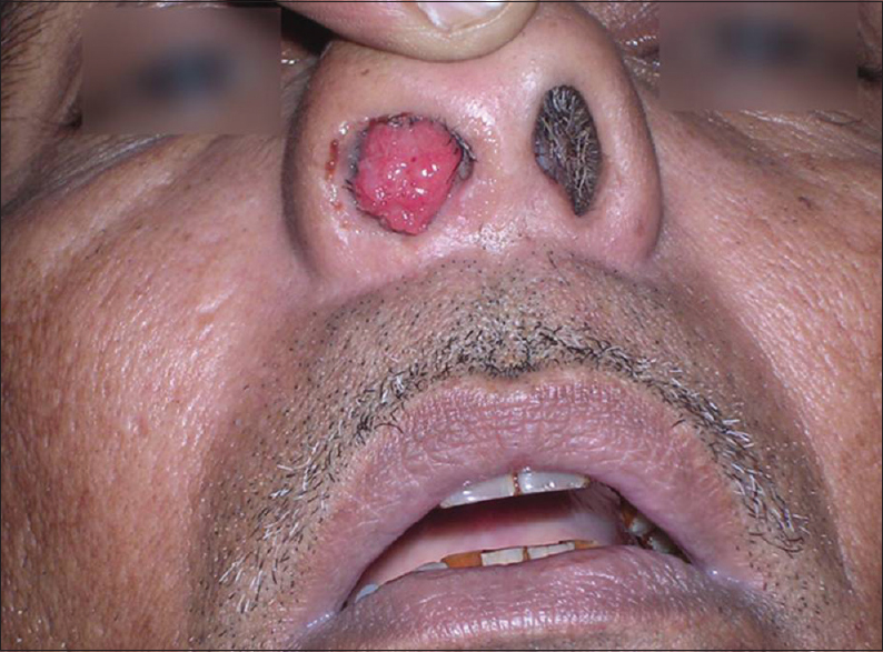 Nấm sâu Rhinosporidosis