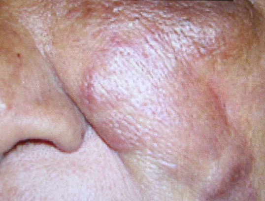 Nấm sâu Zygomycois