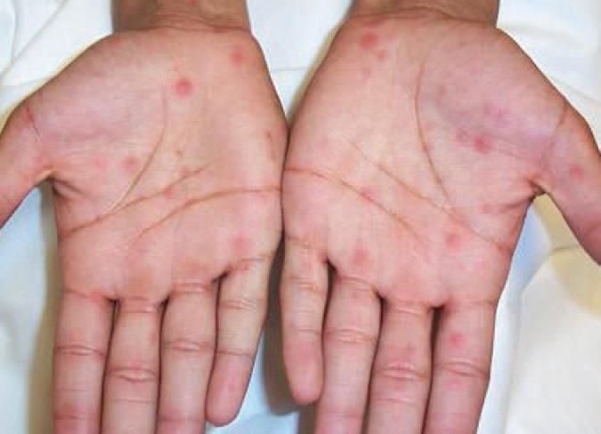 Bệnh lây truyền qua đường tình dục