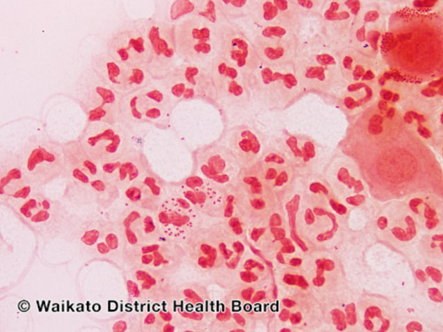 BỆNH LẬU (Gonorrhoeae)