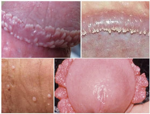 Bệnh Sùi mào gà (Genital warts, Condyloma, Condylomata acuminata)