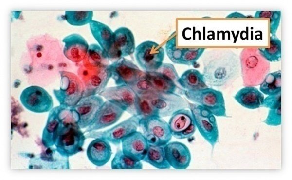 CHLAMYDIA