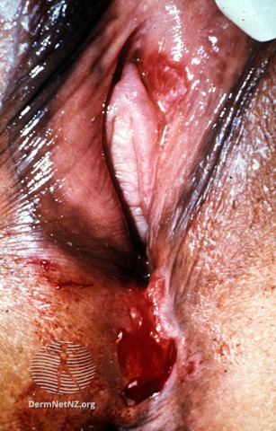 Bệnh Hạ cam (Chancroid)