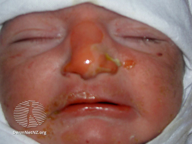 Bệnh da di truyền