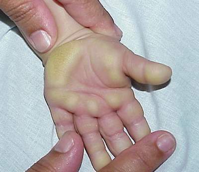 Dày sừng lòng bàn tay, bàn chân (Palmoplantar keratodermas – PPKs)