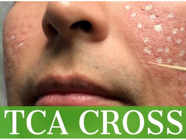 ĐIỀU TRỊ SẸO LÕM BẰNG ACID TRICHLORACETIC