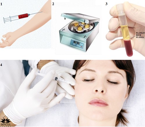 KỸ THUẬT LY TRÍCH HUYẾT TƯƠNG GIÀU TIỂU CẦU (PLATELET RICH PLASMA - PRP)