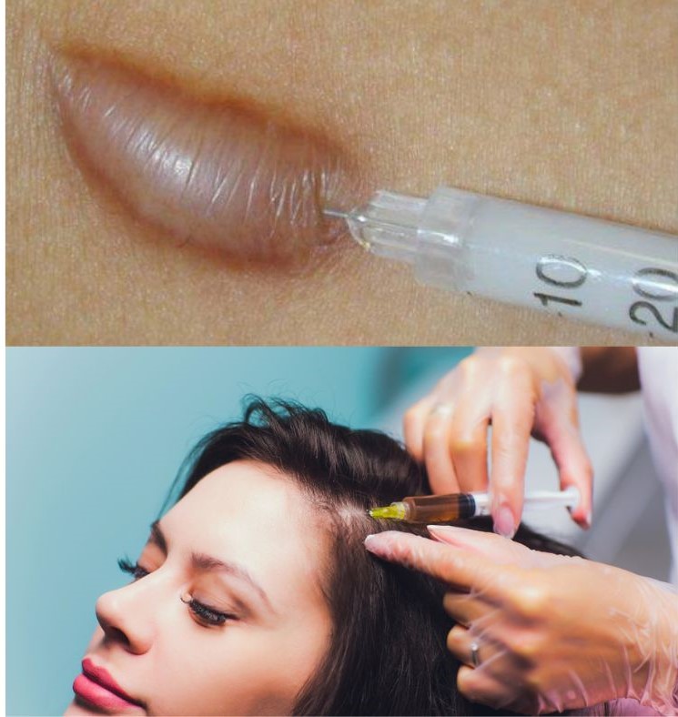 ĐIỀU TRỊ TỔN THƯƠNG DA BẰNG TIÊM THUỐC TRONG THƯƠNG TỔN