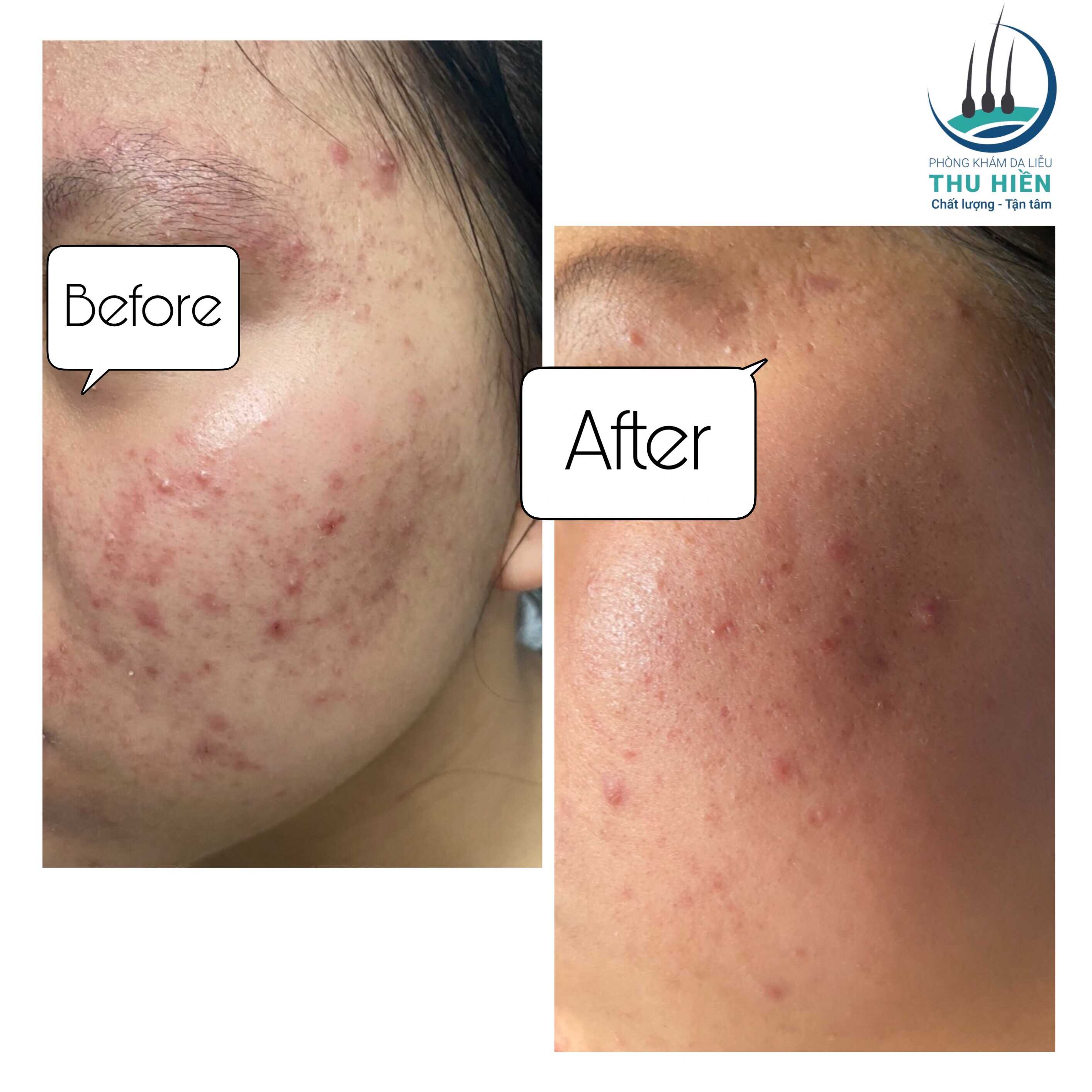 Sau điều trị TRỨNG CÁ