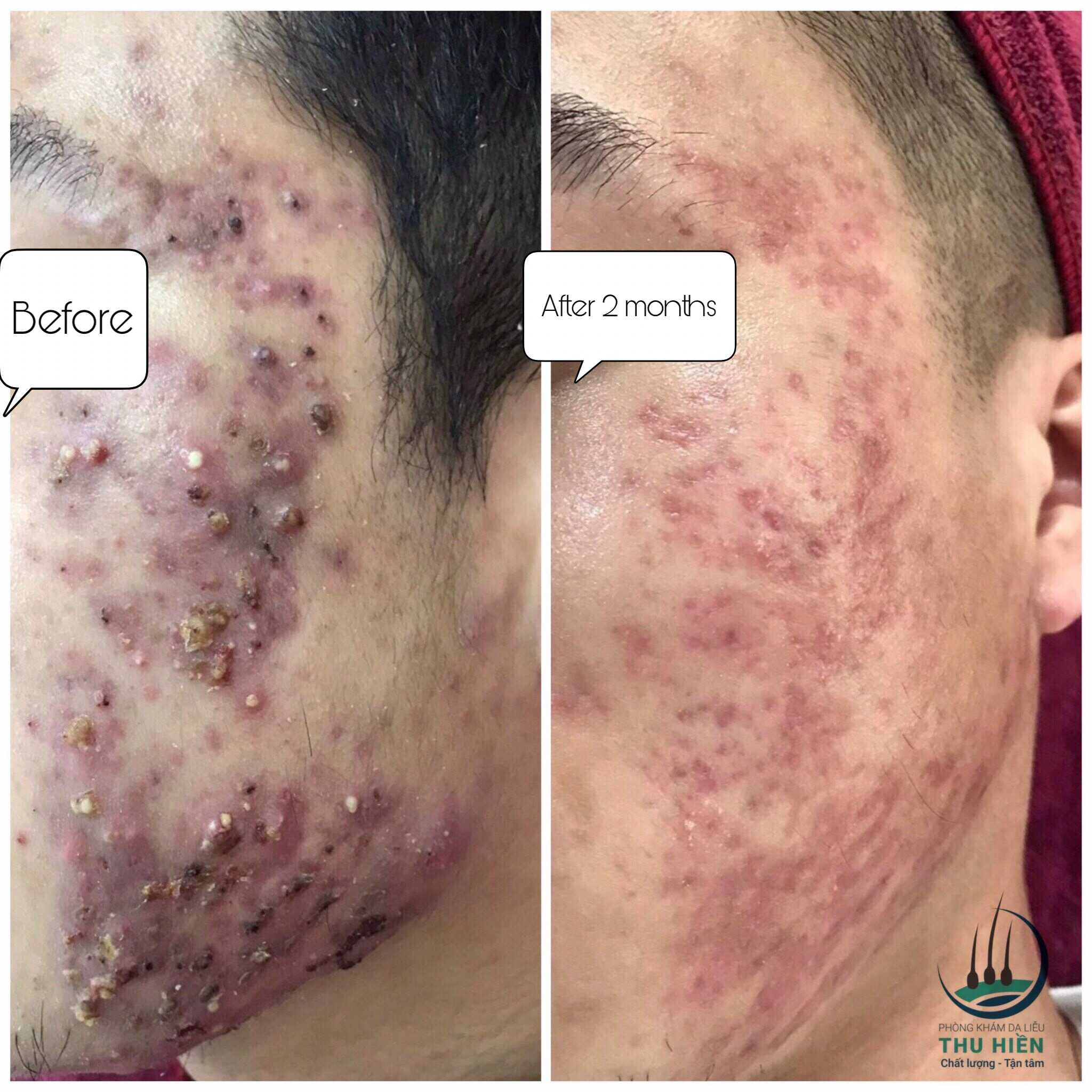 Điều trị Trứng cá bùng phát do Isotretinoin