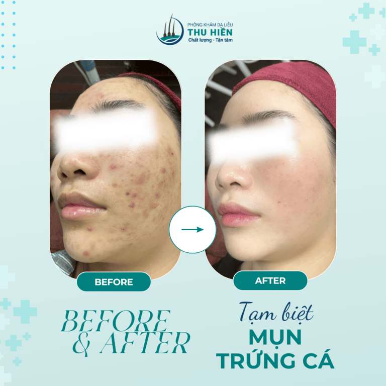  ĐIỀU TRỊ MỤN LÀ HÀNH TRÌNH KIÊN TRÌ CỦA BÁC SĨ VÀ KHÁCH HÀNG