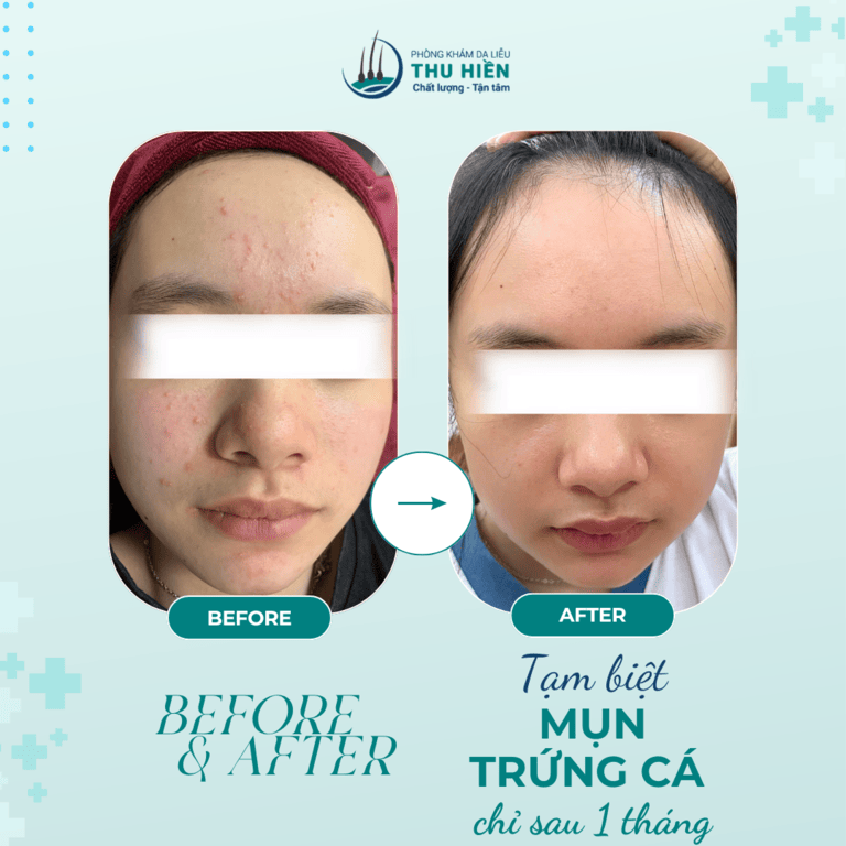 HIỆU QUẢ VƯỢT TRỘI KHI ĐIỀU TRỊ MỤN ĐÚNG CHỈ ĐỊNH, KHÔNG LẠM DỤNG ISOTRETINOIN ĐƯỜNG UỐNG