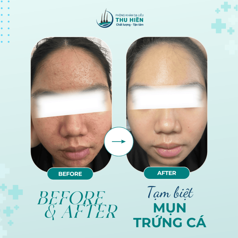  HIỆU QUẢ RÕ RỆT SAU 1 BUỔI VỚI PHÁC ĐỒ CÁ NHÂN HOÁ