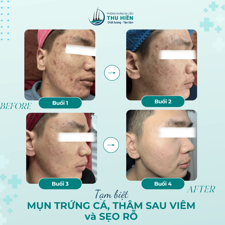 HÀNH TRÌNH 4 BUỔI, DA KHỎE ĐẸP NGOẠN MỤC! 