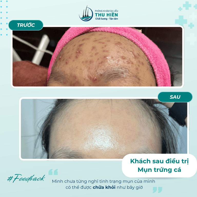 Trộm vía chúng tôi cứ chữa mụ.n khỏi đều đều cho khách hàng thế thôi hẹ hẹ hẹ   Ai bị tình trạng mụn