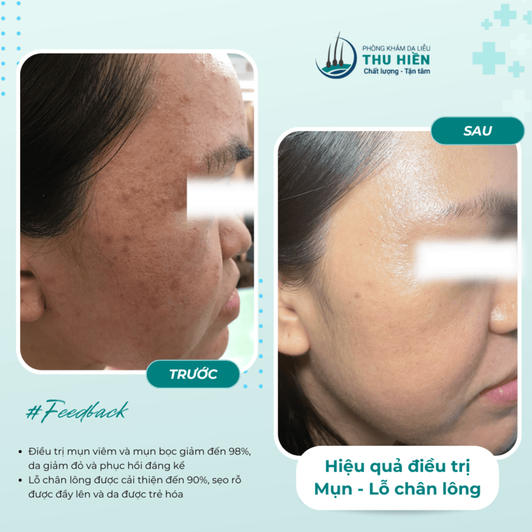  TỪ MỤN ĐẾN MỊN – DA ĐẸP KHÔNG CÒN LÀ ƯỚC MƠ! 