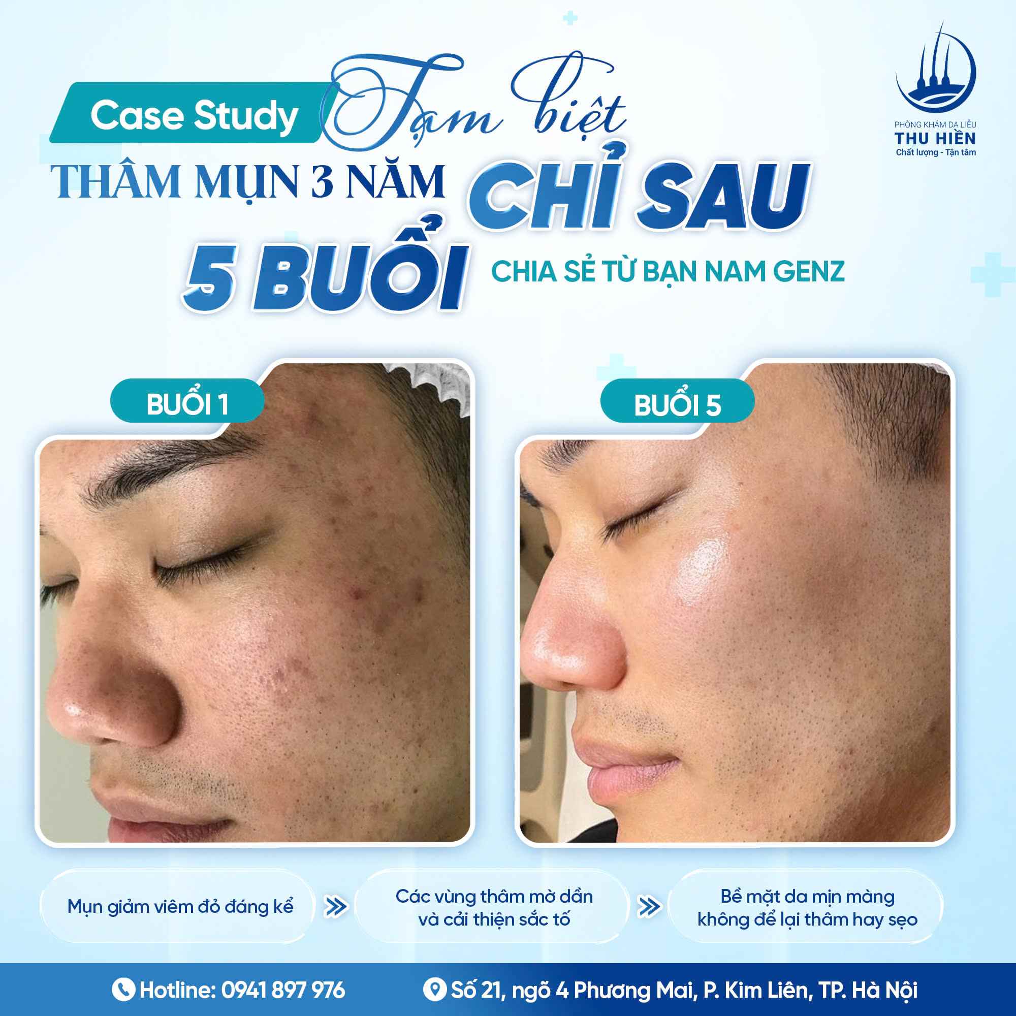 [Case Study] Giảm thâm mụn đáng kể chỉ sau 5 buổi – Chia sẻ từ bạn nam GenZ