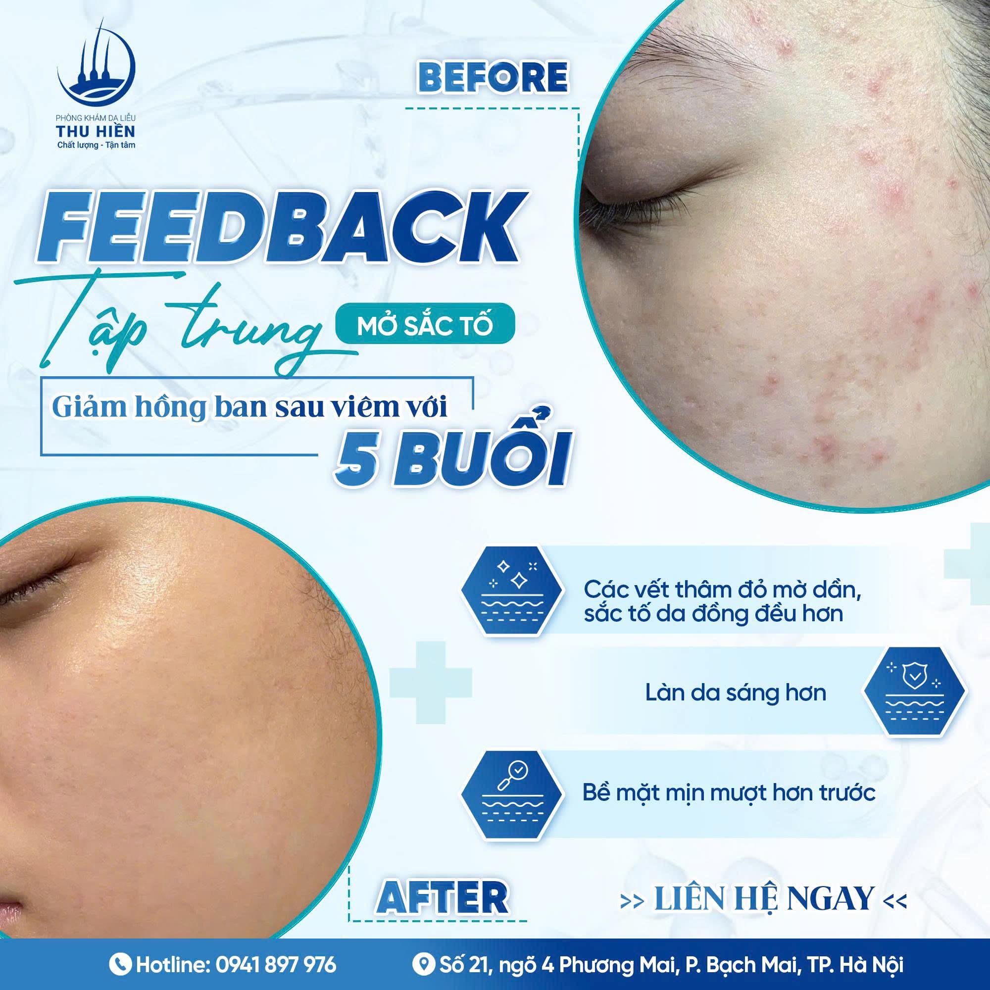 𝐅𝐄𝐄𝐃𝐁𝐀𝐂𝐊 | TẬP TRUNG MỜ SẮC TỐ - GIẢM THÂM M.ỤN SAU 5 BUỔI