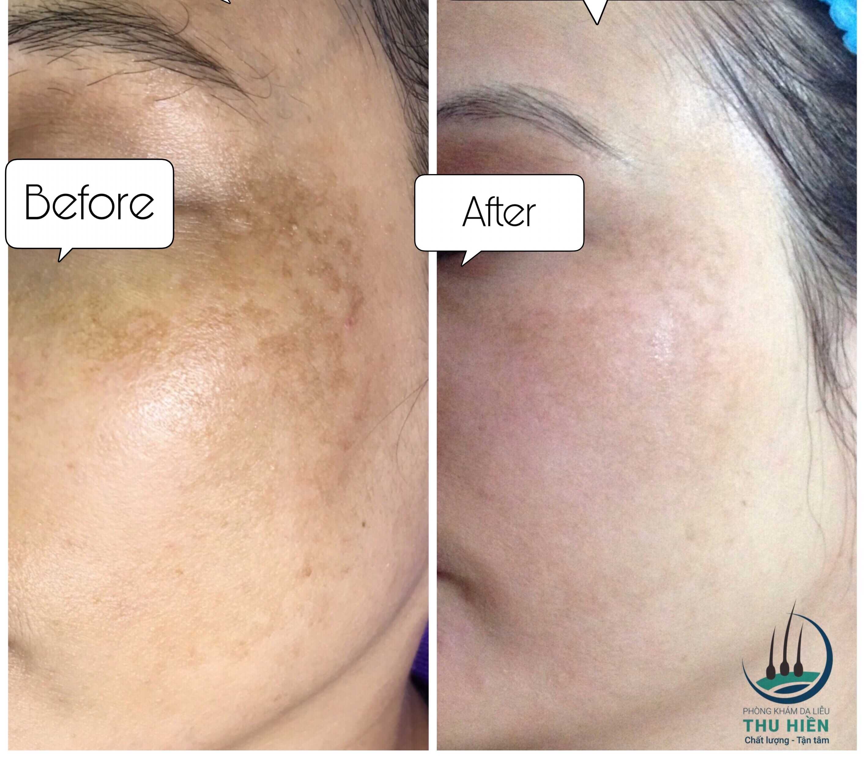 Sau điều trị rám má bằng tiêm vi điểm