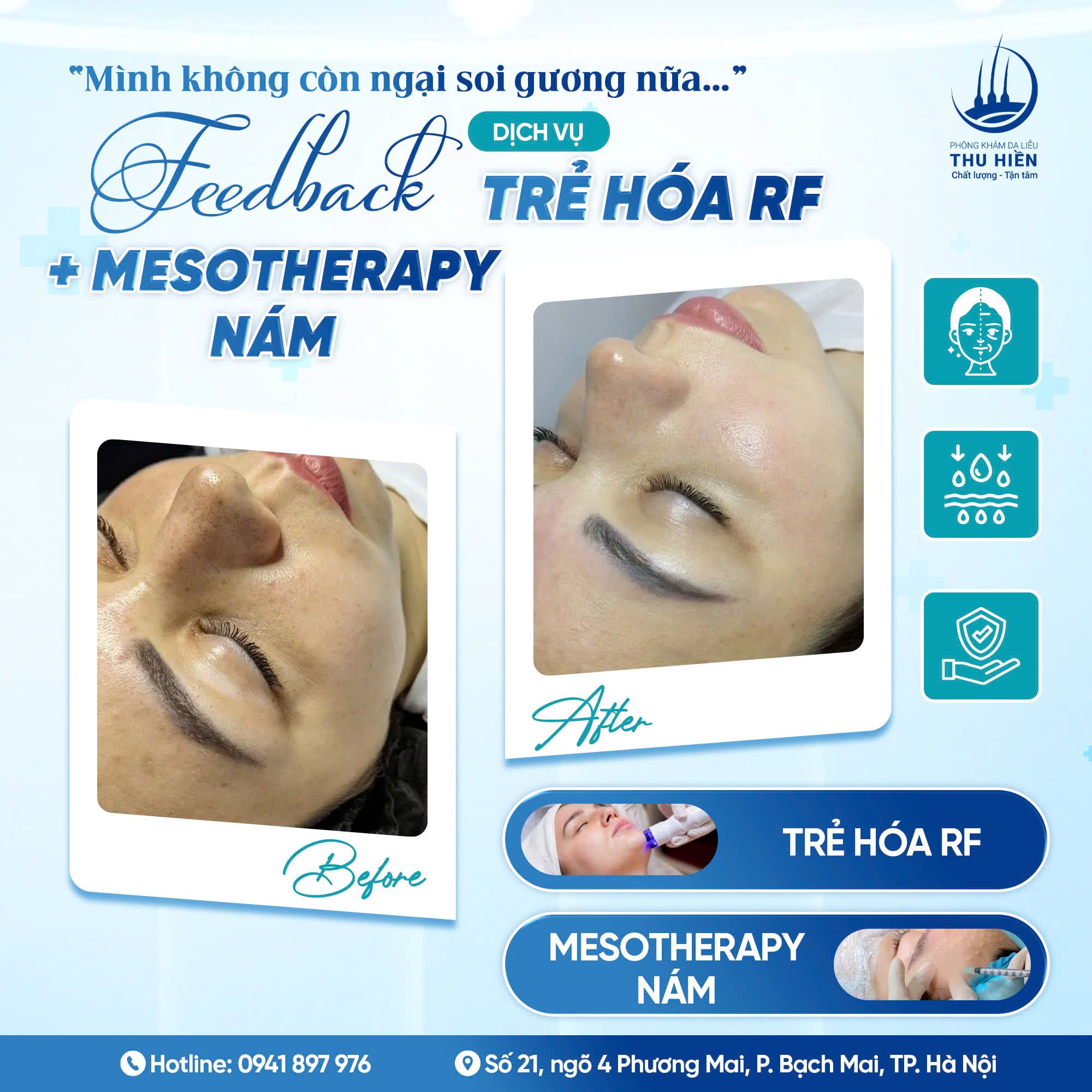 “TỰ DƯNG CHỊ XUẤT HIỆN NHỮNG VẾT NÁM” - Feedback dịch vụ trẻ hóa RF + Mesotherapy nám