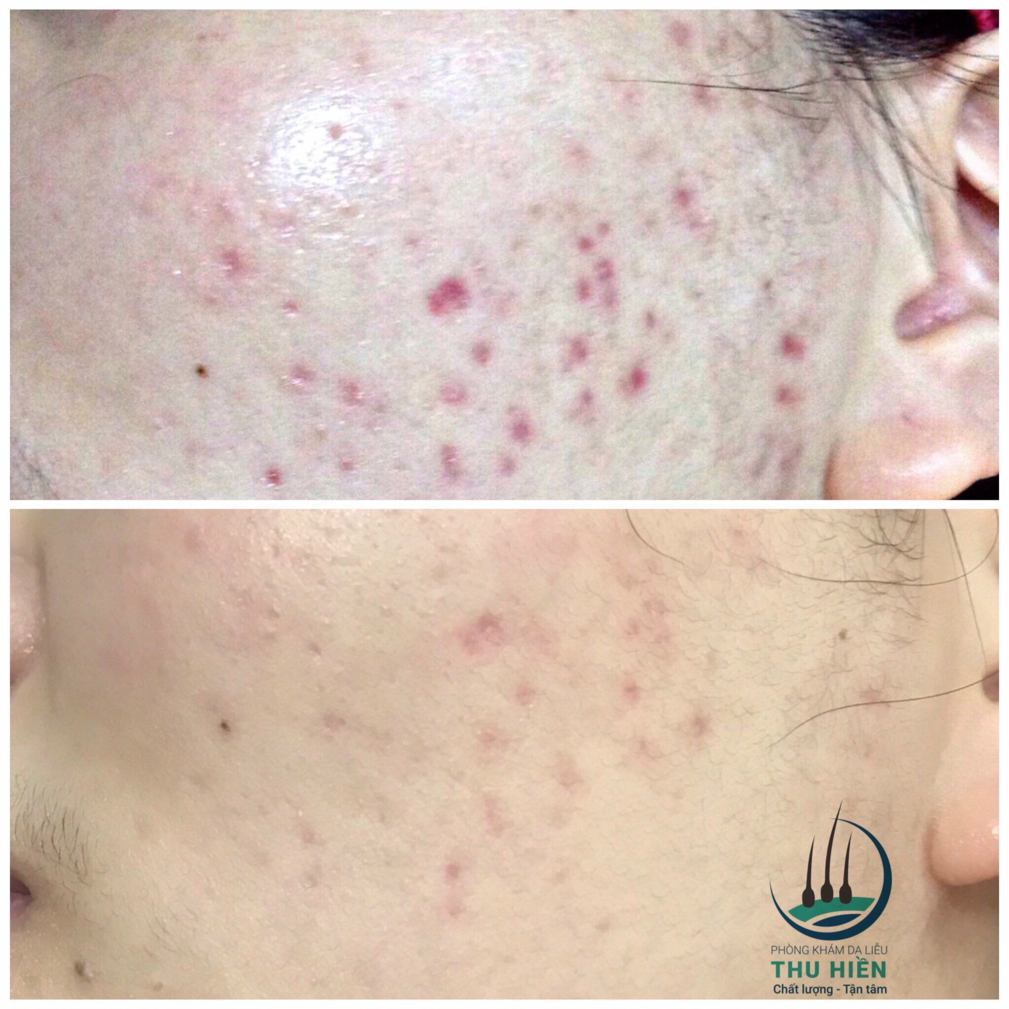 Kết quả điều trị sẹo lõm bằng lăn kim