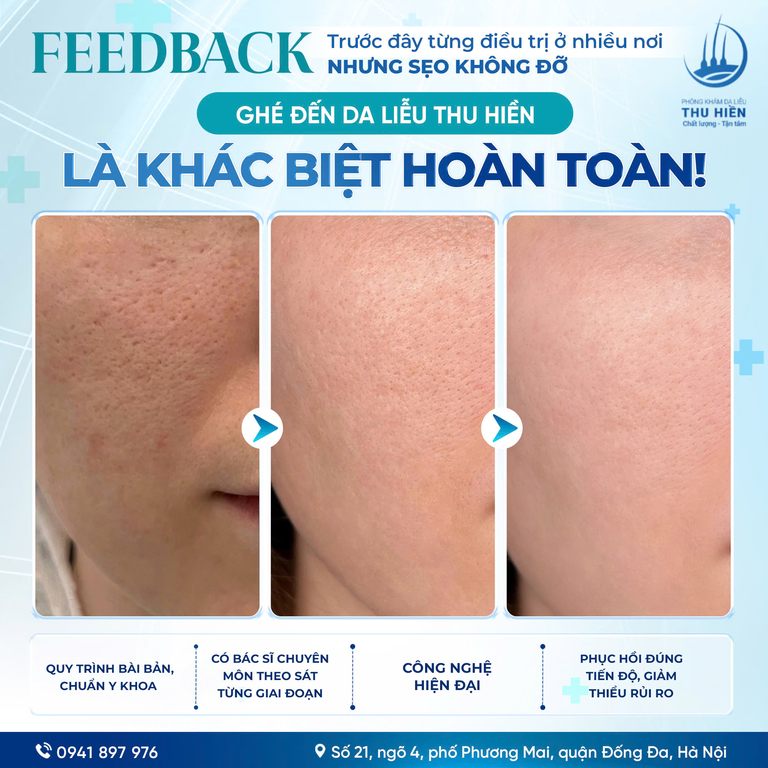 𝐅𝐄𝐄𝐃𝐁𝐀𝐂𝐊 | Trước đây từng đ.iều t.rị ở nhiều nơi nhưng s.ẹo đáy nhọn không đỡ