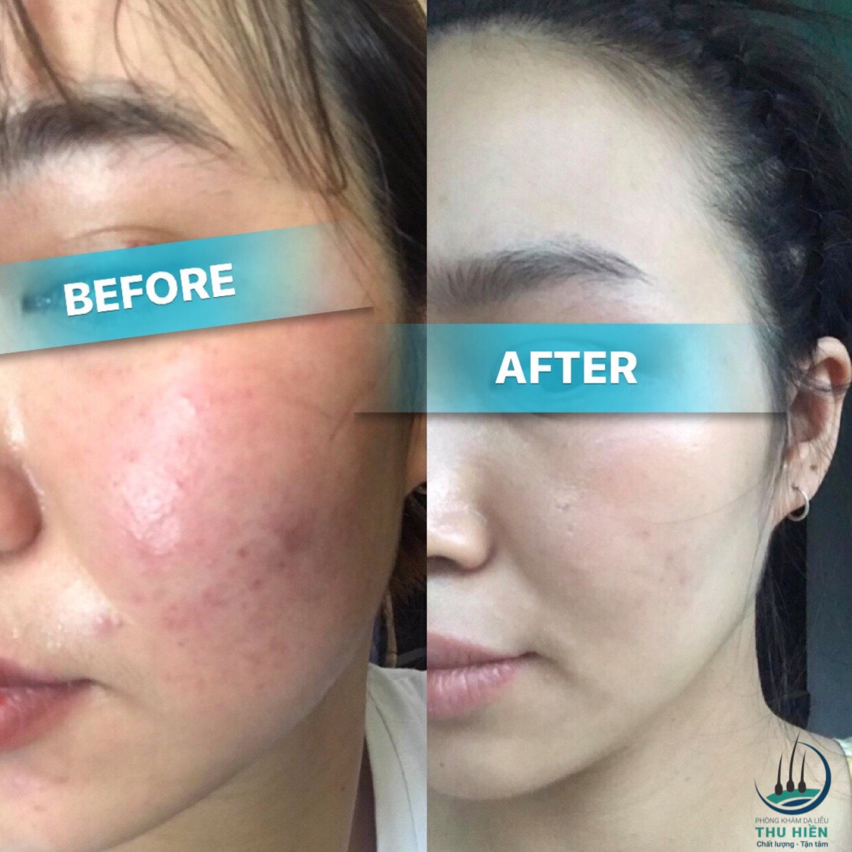 Viêm da do demodex trước sau điều trị