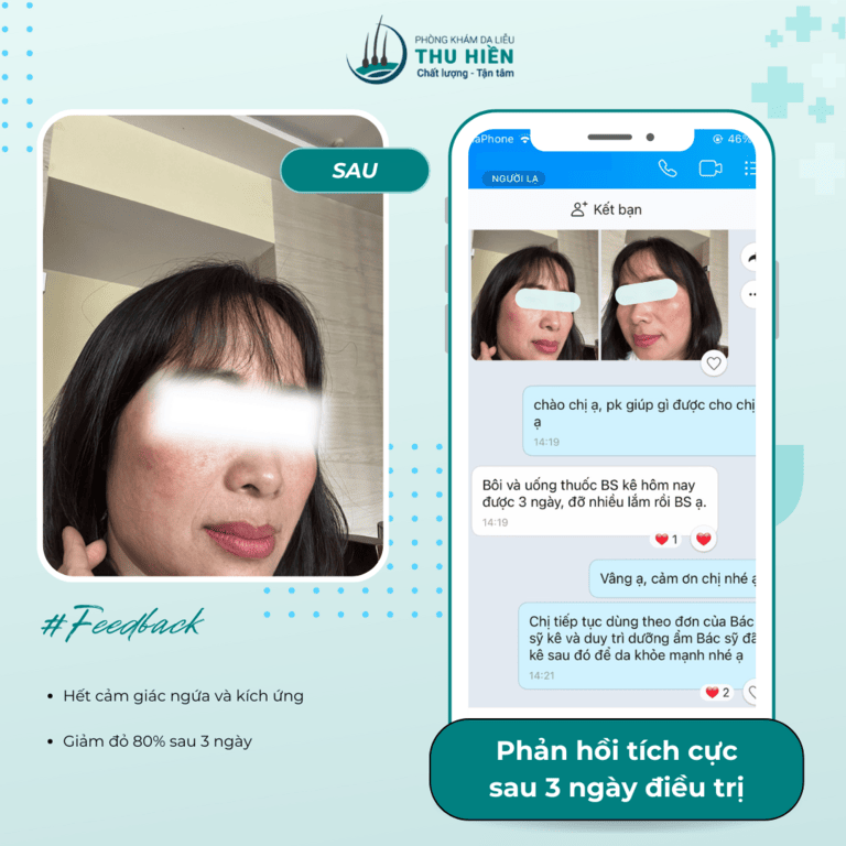 KÍCH ỨNG DA – KHÔNG CÒN NỖI LO NHỜ CÓ DA LIỄU THU HIỀN! 