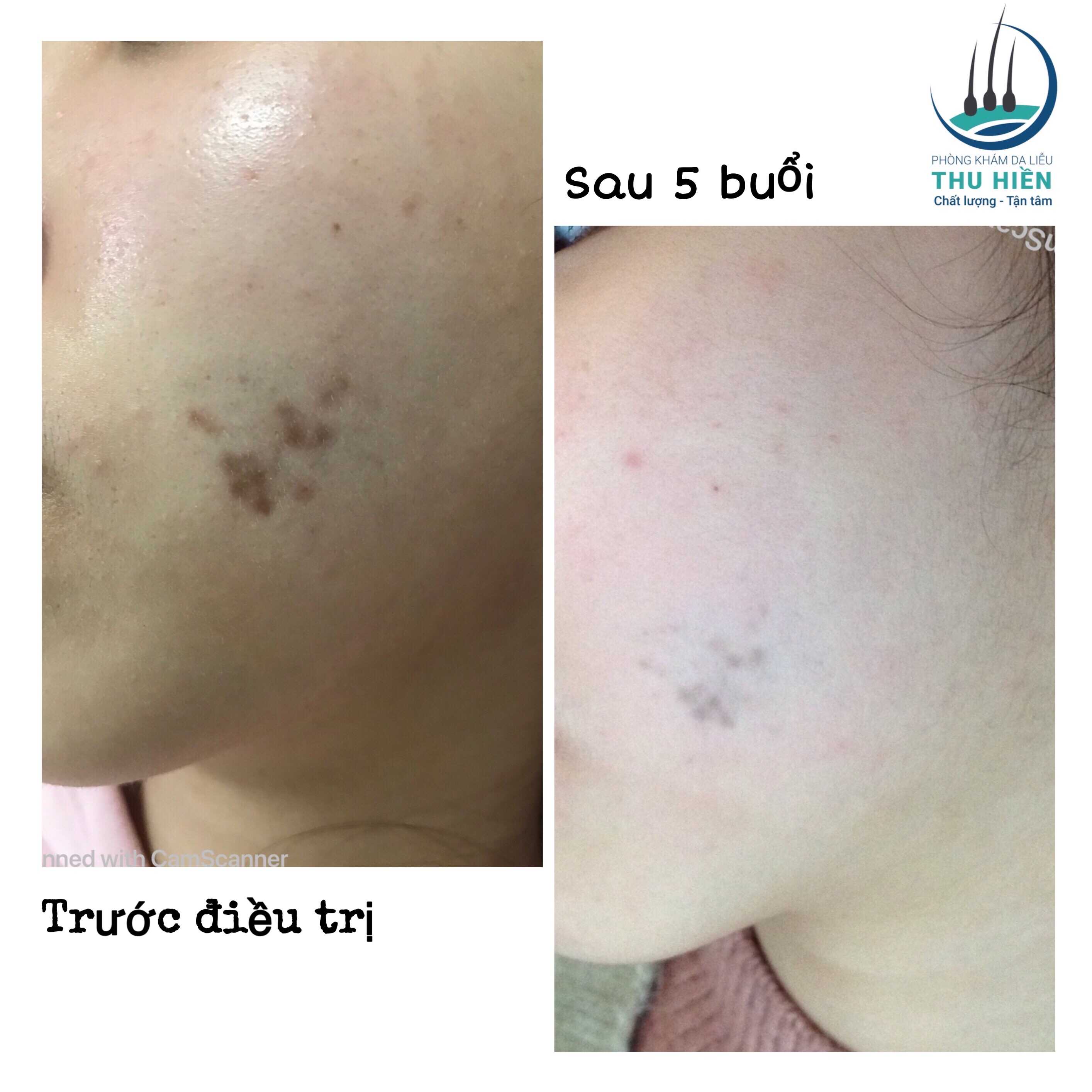 Sau điều trị một số tổn thương da (nốt ruồi, bớt sắc tố...)