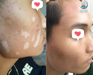 Sau điều trị bạch biến bằng chiếu đèn UVB