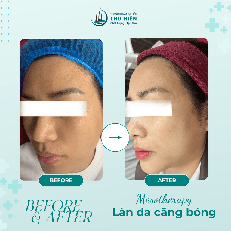  CHỈ SAU 1 LIỆU TRÌNH MESO – LÀN DA ĐÃ CĂNG BÓNG RẠNG RỠ! 