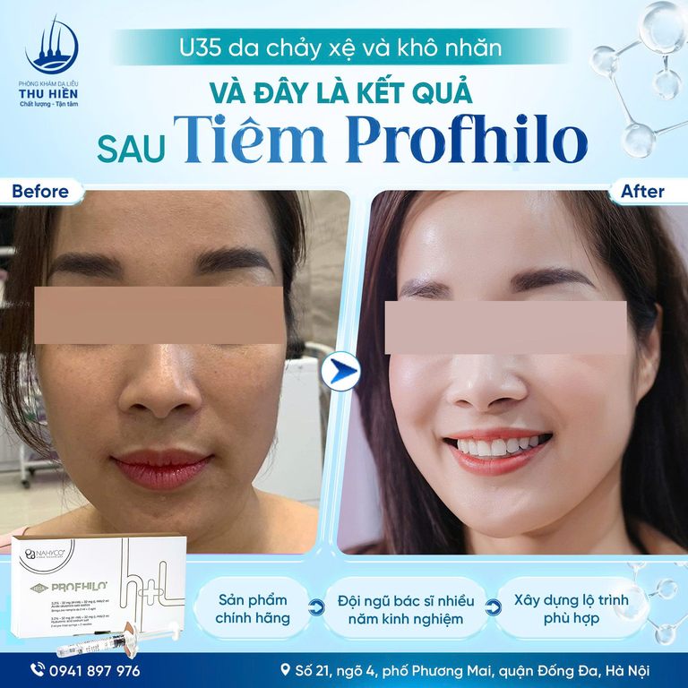U35 da chảy xệ và khô nhăn… Và đây là chuyện sau #1_liệu_trình 𝗍𝗂𝖾̂𝗆 #Profhilo