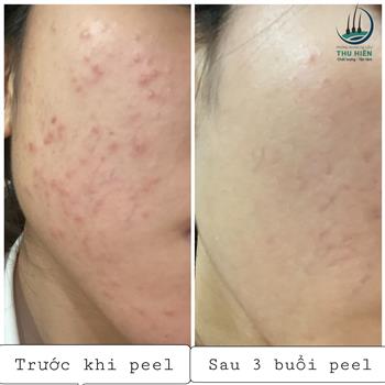  ⭐PEEL DA - PHƯƠNG PHÁP LÀM ĐẸP HOÀN HẢO CHO MÙA ĐÔNG NÀY⭐