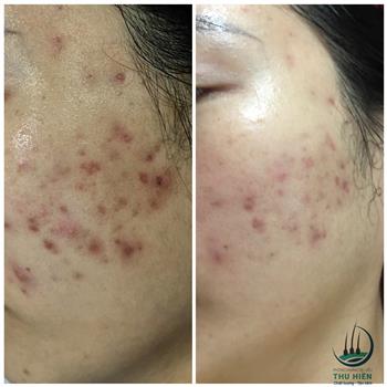 🤔BẠN MUỐN SẠCH MỤN MÀ KHÔNG CẦN UỐNG THUỐC🤔