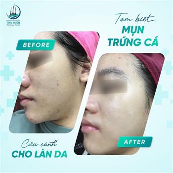 BÍ QUYẾT ĐIỀU TRỊ MỤN TRỨNG CÁ ĐÚNG CÁCH ĐỂ DUY TRÌ HIỆU QUẢ SẠCH MỤN LÂU DÀI 