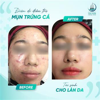 ĐIỆN CHUYỂN ION ĐIỀU TRỊ MỤN TRỨNG CÁ - TÁI SINH CHO LÀN DA CHỈ SAU 5 BUỔI 