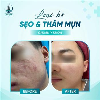 THẤU HIỂU LÀN DA CỦA BẠN, LOẠI BỎ SẸO VÀ THÂM MỤN CHUẨN Y KHOA!
