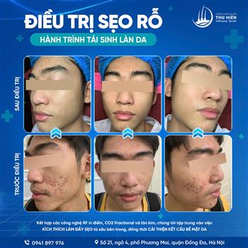 ĐIỀU TRỊ S.ẸO RỖ - HÀNH TRÌNH TÁI SINH LÀN DA