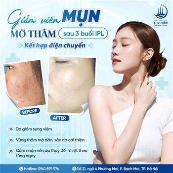 [BEFORE - AFTER] Giảm v.iêm m.ụn, mờ thâm sau 3 buổi IPL kết hợp điện chuyển