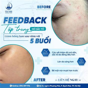 𝐅𝐄𝐄𝐃𝐁𝐀𝐂𝐊 | TẬP TRUNG MỜ SẮC TỐ - GIẢM THÂM M.ỤN SAU 5 BUỔI