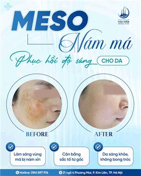 MESO NÁM MÁ - PHỤC HỒI ĐỘ SÁNG CHO DA